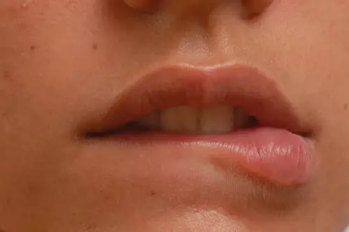Swelling After Lip Filler
