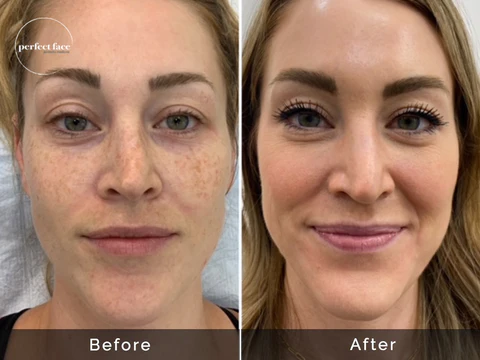 Microneedling Before and After
