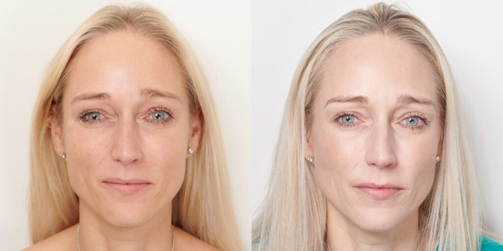 Profhilo Before and After