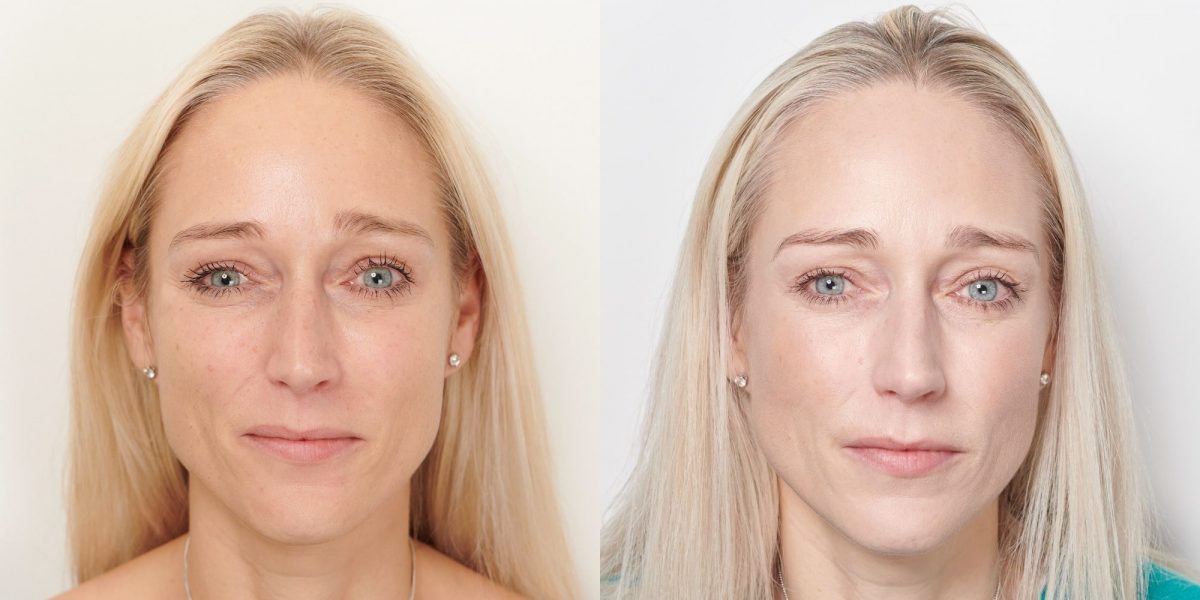 Profhilo Before and After